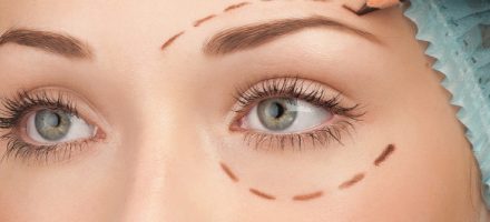 blépharoplastie blepharoplasty lausanne