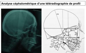 Chirurgie du menton