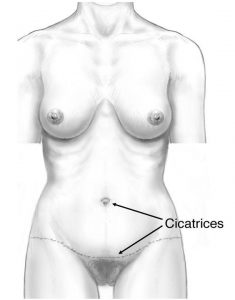 cicatrices-de-la-plastie-abdominale-classique