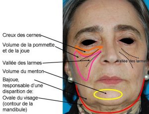 injections Acide hyaluronique visage