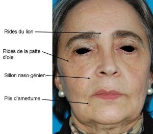 injections Acide hyaluronique Suisse