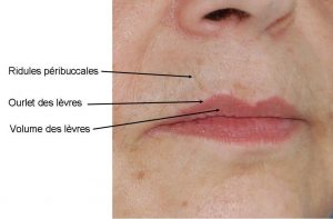 injections Acide hyaluronique lèvres