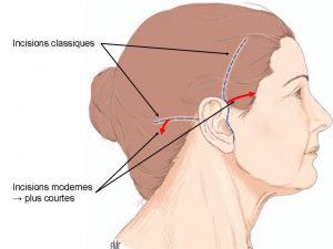 lifting cervico-facial Genève