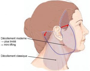 lifting cervico-facial Suisse