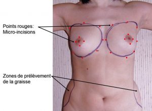 Lipofilling seins