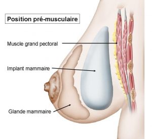 Implant mammaire