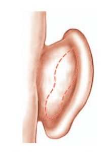 incision-cicatrice-otoplastie