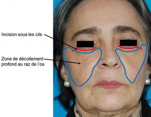 Lifting centro-facial