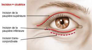 Incisions pratiquées sur la paupière lors de la blépharoplastie