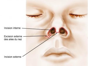 incisions-rhinoplastie