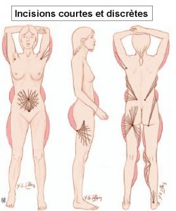 incsions-de-la-lipoaspiration