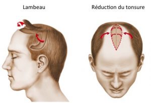 greffe de cheveux lambeau et tonsure