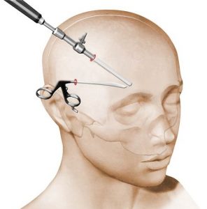 lifting-fronto-temporal-endoscopique