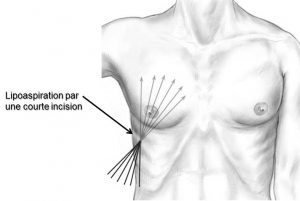 lipoaspiration-du-thorax