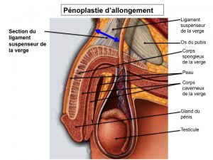 Phalloplastie Suisse