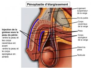 Pénoplastie Suisse