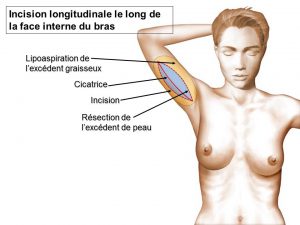 plastie-brachiale-longitudinale