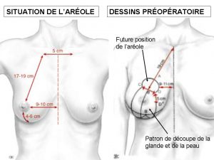 Mastopexie et lifting des seins