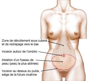 principe-de-la-plastie-abdominale-classique