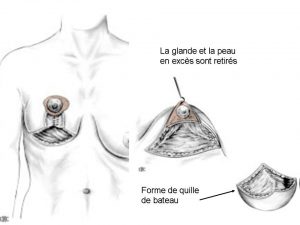 Réduction mammaire Suisse