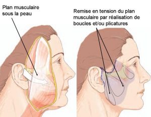 remise-en-tension-musculaire