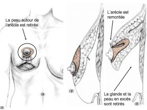 Réduction ptose mammaire