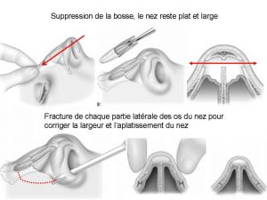 rhinoplastie Genève