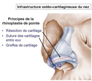 rhinoplastie pointe du nez