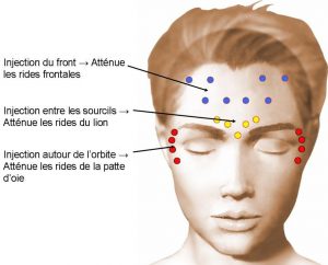 sites-dinjection-toxine-botulique