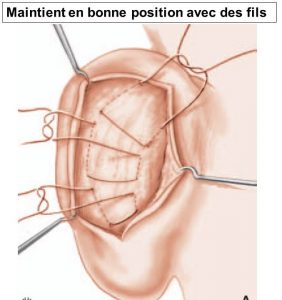 sutures-du-cartilage