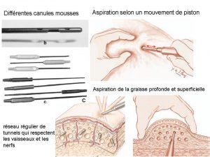 Lipoaspiration en Suisse