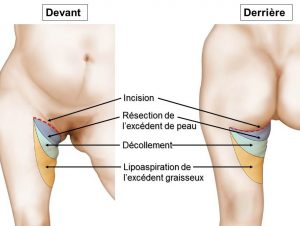 technique-de-la-plastie-crurale