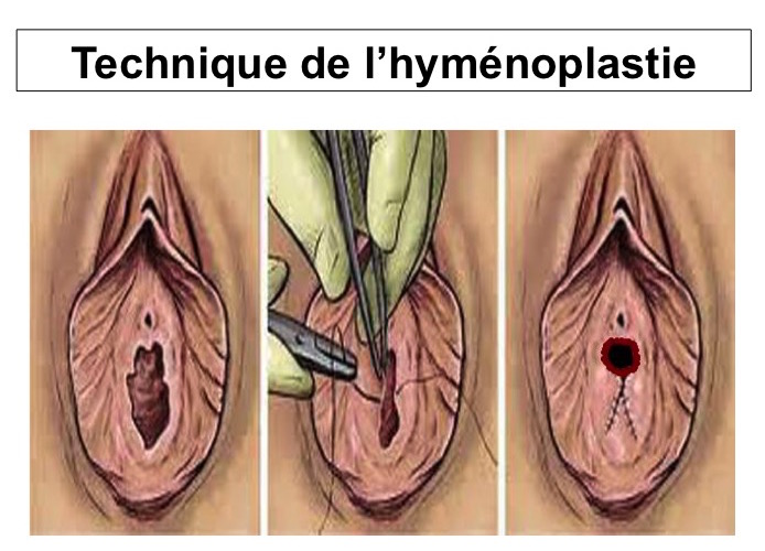 Hymenoplastie Avant Apres