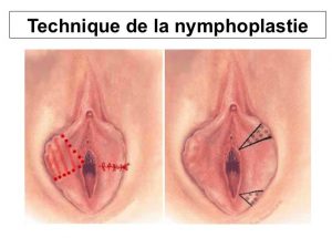 Nymphoplastie Suisse