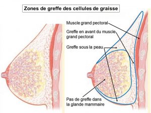 Lipostructure seins