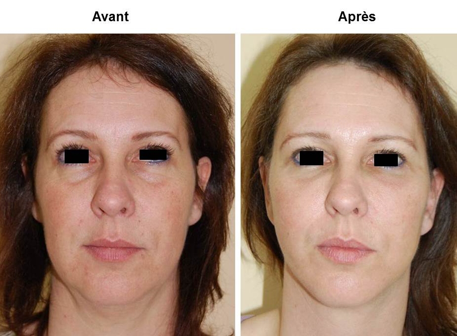 lipofilling visage lausanne