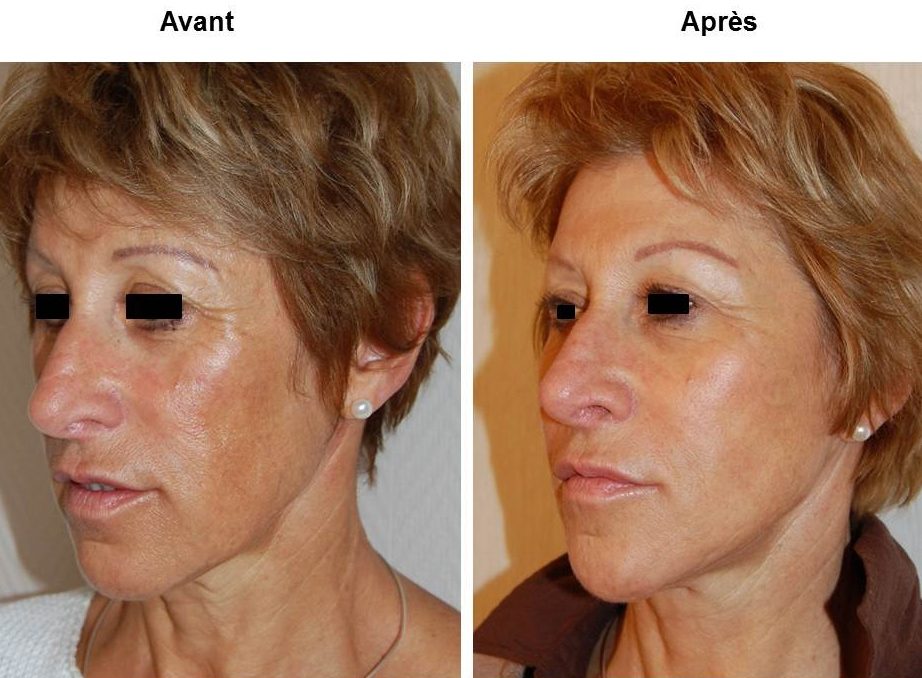 lipofilling visage geneve