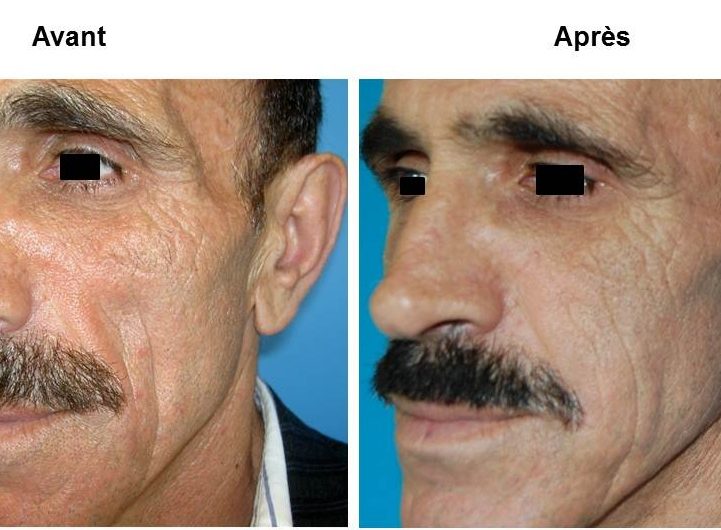 lipostructure visage geneve