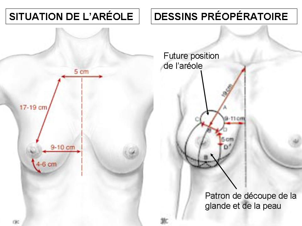 Breast reduction Switzerland : cosmetic surgery for breast reduction - Dr  Bayol