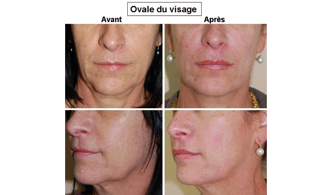 comblement ovale du visage geneve
