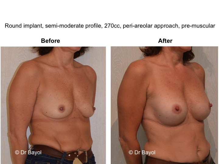 breast augmentation switzerland