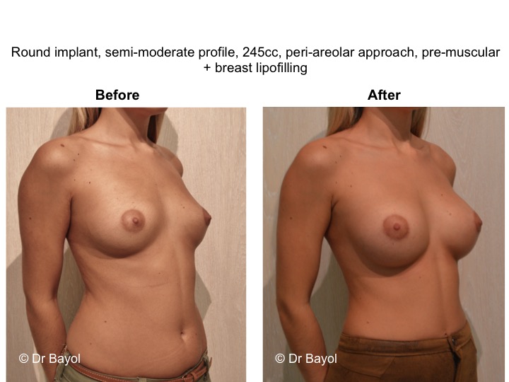 breast implant geneva