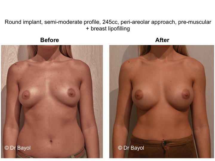 breast implant switzerland