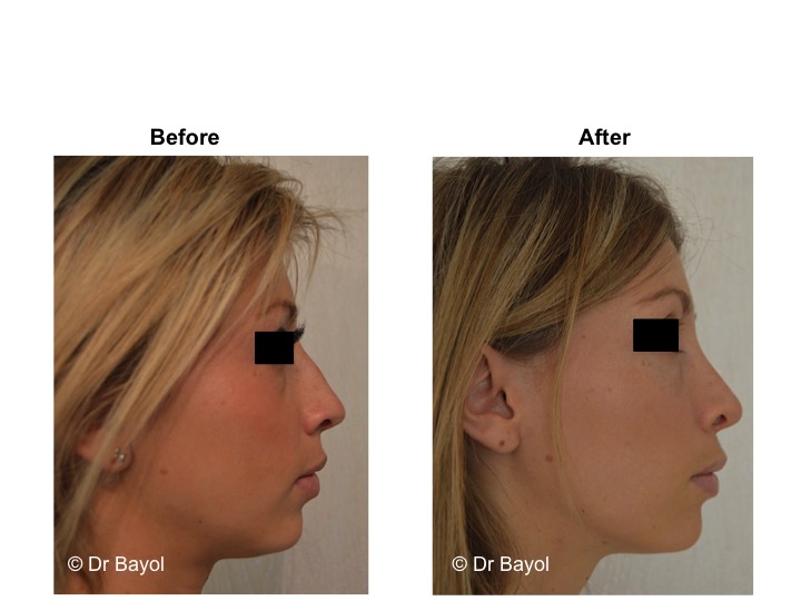 price rhinoplasty geneva