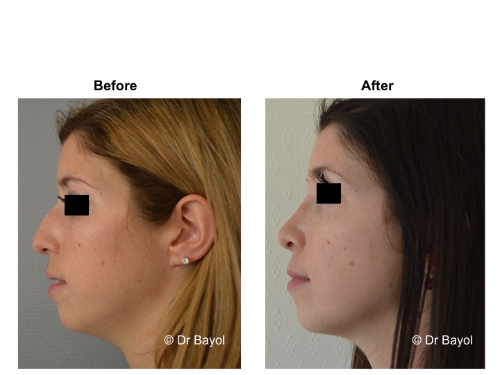 best plastic surgeon rhinoplasty lausanne