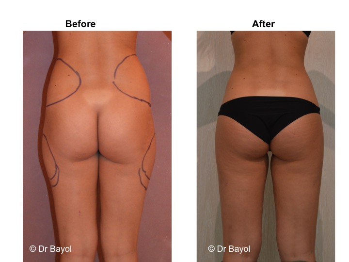 traitement lipoaspiration geneve