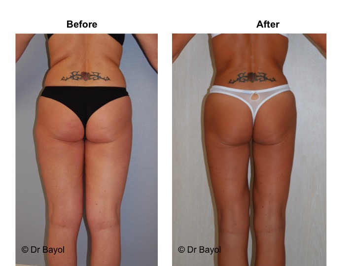 lipoaspiration a geneve