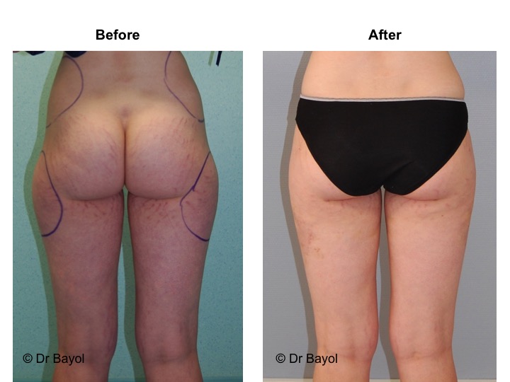 lipoaspiration lausanne