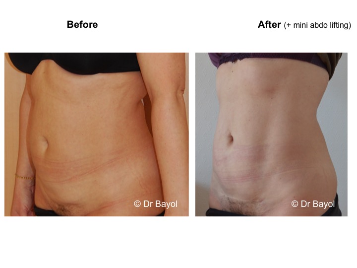 mini plastie abdominale geneve