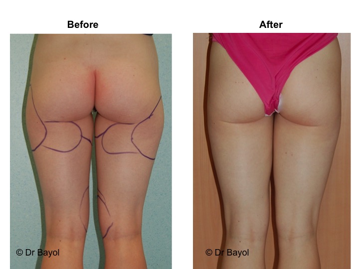 chirurgie liposuccion geneve